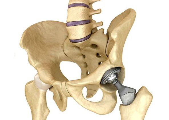 Endoprosthetics an chomhpháirt cromáin