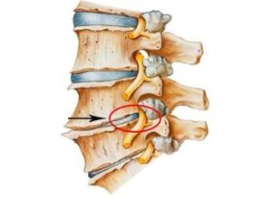 Comharthaí agus Comharthaí Osteochondrosis