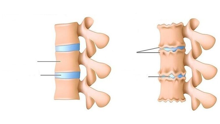 spine sláintiúil agus spine tionchar ag osteochondrosis