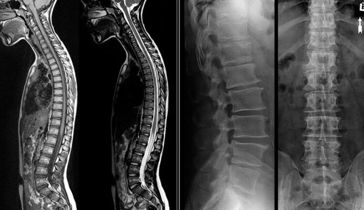 Pictiúir X-gha agus MRI le haghaidh osteochondrosis