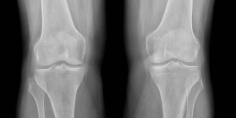 osteoarthritis glúine x-gha