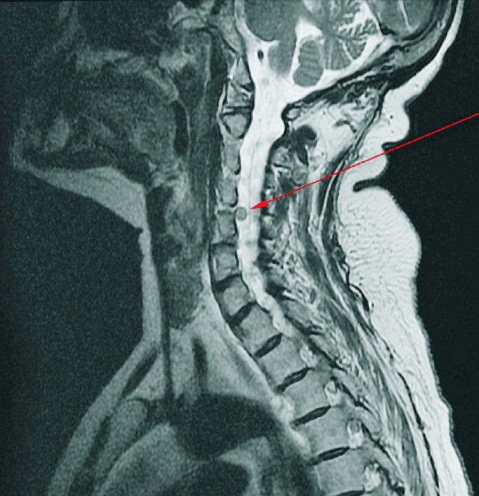 Hernia intervertebral an spine cheirbheacsach ar MRI