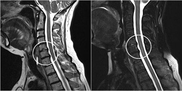 MRI den spine ceirbheacsach le comharthaí osteochondrosis