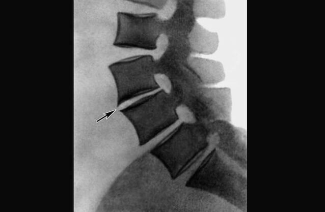 Léirithe osteochondrosis an spine chliabhraigh ar an radiograph