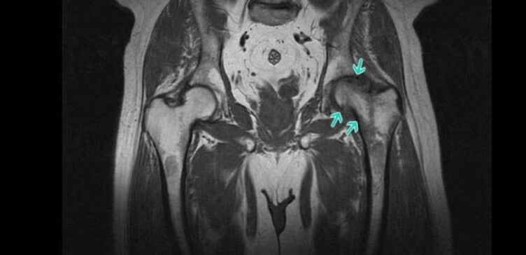 Athruithe degenerative-dystrophic sa comhpháirteach cromáin ar MRI