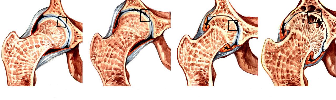 Céimeanna dífhoirmithe coxarthrosis