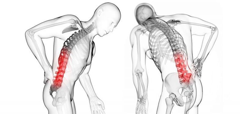 deacrachtaí le osteochondrosis ceirbheacsach